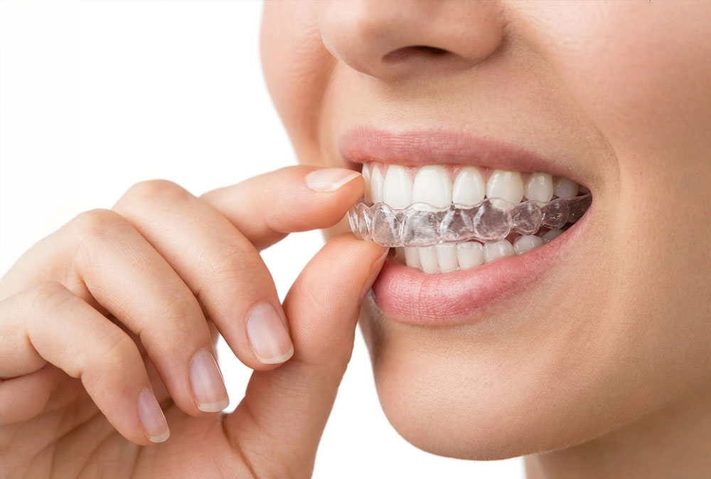 Clear aligner orthodontic treatment for discreet teeth correction in Bali