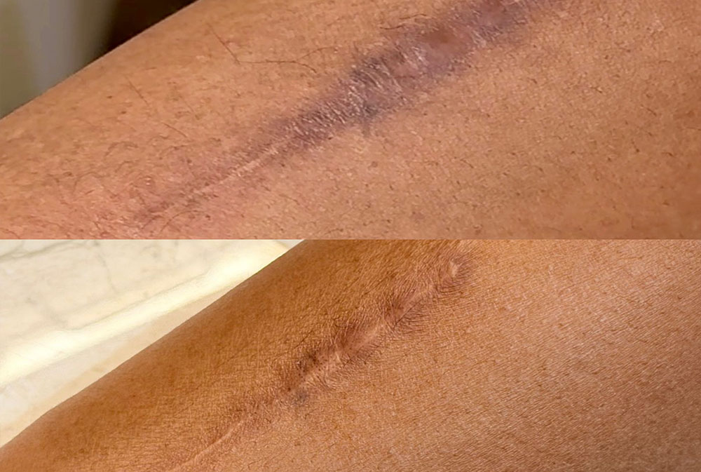 CO2 laser resurfacing treatment in Bali