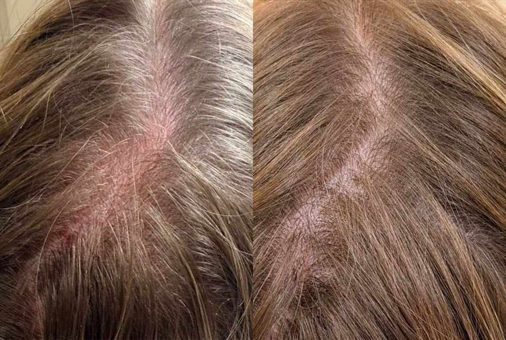 Hair restoration and hair loss therapy in Bali